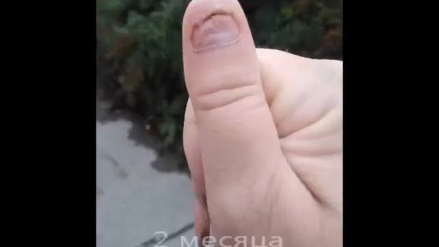 рост ногтя после удаления смотреть онлайн