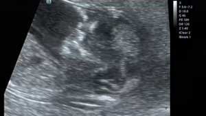 Наш будущий малыш. Первое Узи - 12 недель, 4 дня.