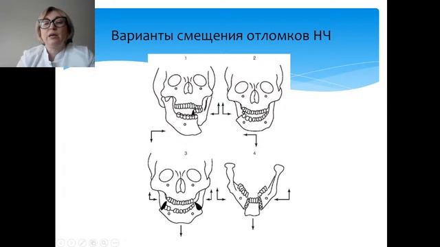 Лекция к.м.н., доцента Самуткиной М.Г. : Травмы ЧЛО смотреть онлайн