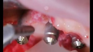 Периимплантит