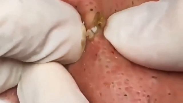 粉刺 粟粒腫 Сдавить прыщи Черные точки Dermatologist video to press pimples Тебя стошнит от этого видео смотреть онлайн