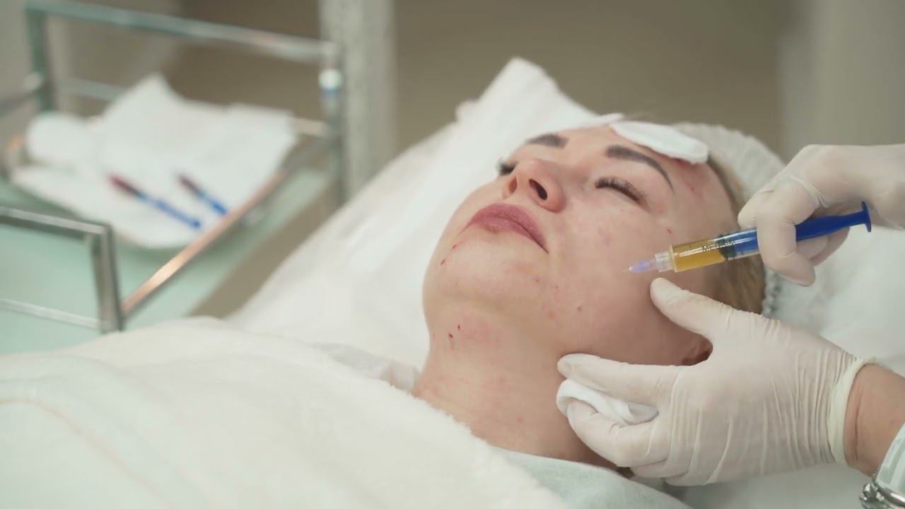 Плазмотерапия Cortexil PRP