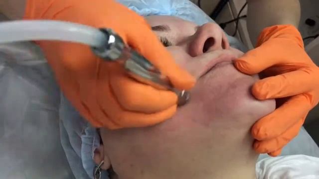 Алмазная микродермабразия смотреть онлайн