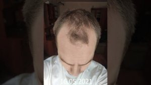 Миноксидил - результат через год. 10 месяцев использования. Да или нет?