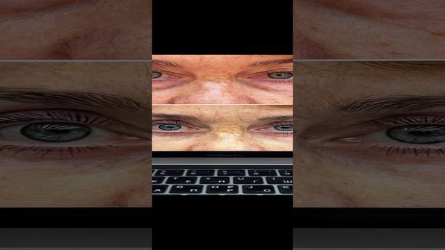 Верхняя и нижняя блефаропластика
