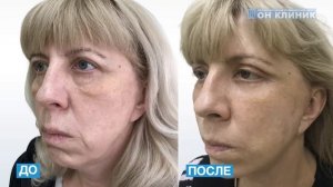 Спейслифтинг в ОН КЛИНИК. ДО/ПОСЛЕ 2021
