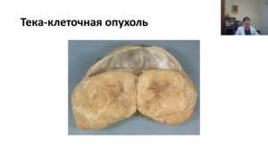 Опухоли яичника.mp4