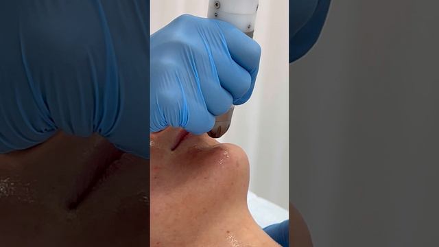 Безинъекционная мезотерапия Дермадроп - насыщение кожи лица сыворотками без игл и стресса | GEN87