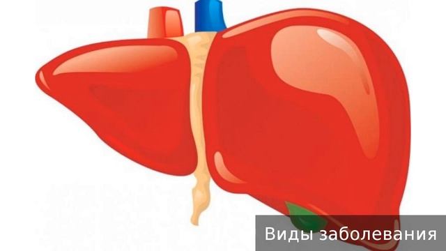 Гепатомегалия. Как лечить гепатомегалию.