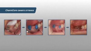 Новинка! Композитный цемент двойного отверждения CharmCore для наращивания культи.