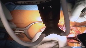 Lumbar Fusion - live surgery with Rod Oskouian, MD⠀