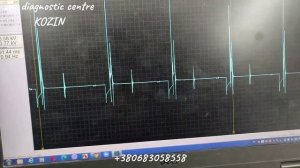 Mitsubishi ошибка по катализатору и пропуски воспламенения