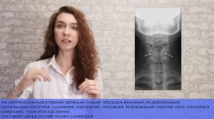 Рентген: остеохондроз позвоночника