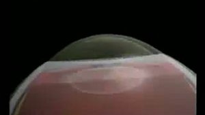 Внутриглазное давление