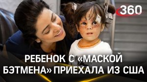 Американка Луна Феннер с «маской Бэтмена» вернулась в Россию ради новой пластической операции