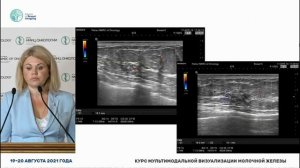 УЗИ внутрипротокового рака молочной железы