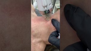 Семинар «Микроигольчатый РФ-лифтинг»