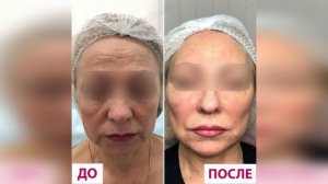 Результаты омоложения лица с помощью инъекций