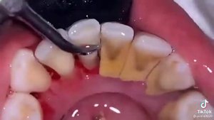 Зубной камень