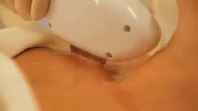 Эпиляция волос SHR смотреть онлайн