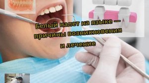 Белый налет на языке — причины возникновения и лечение