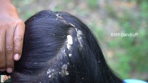 Psoriasis treatment - Huge Flakes, Dandruff Scratching #134