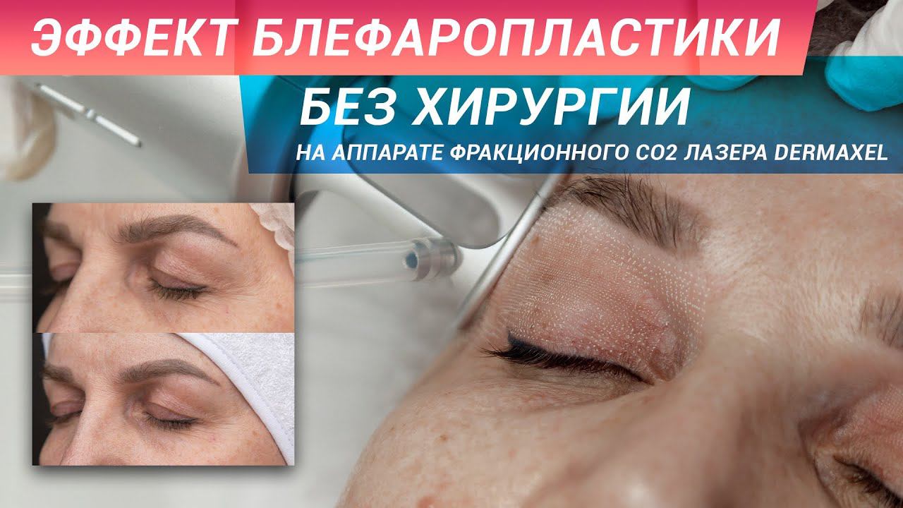 Лазерное омоложение век с эффектом блефаропластики  за одну процедуру