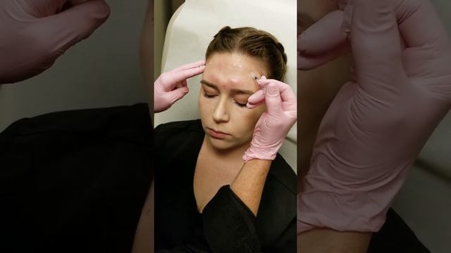 Botox for Glabella Area at Mystique Medical Spa in Fresno, California