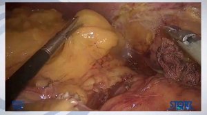 Лапароскопически ассистированная левостороння гемиколэктомия с применением ICG