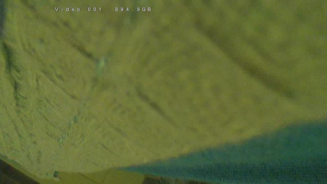 Лапароскопическая резекция сигмовидной кишки с резекцией тонкой кишки, мочевого пузыря (Видео 7) смотреть онлайн