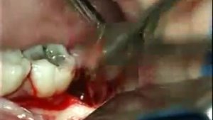 Удаление 3 нижнего моляра.flv