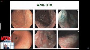 Доброкачественные новообразования желудка. Эндоскопическая диагностика.