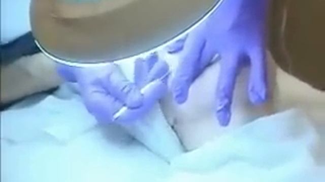 Wisconsin Skin Rejuvenation with Dermaplaning смотреть онлайн