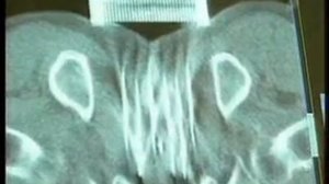 Брахитерапия в лечении рака предстательной железы