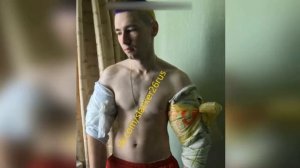 «Руки-базуки» лопнули: качОк из Пятигорска удалил себе надувные бицепсы