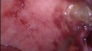 Периаппендикулярный инфильтрат