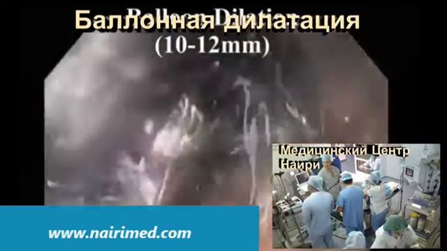 Пероральная эндоскопическая миотомия в МЦ Наири смотреть онлайн