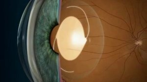 Выбор искусственного хрусталика