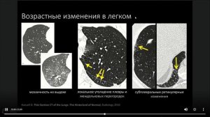 Анатомия легочной дольки, возрастные особенности, варианты нормы 2