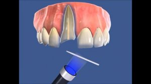 Как восстановить передний зуб. Реставрация резца. Терапевтическая стоматология