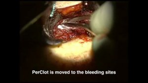 Нейрохирургия спинальная