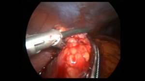 Биопсия лимфоузла при мезадените