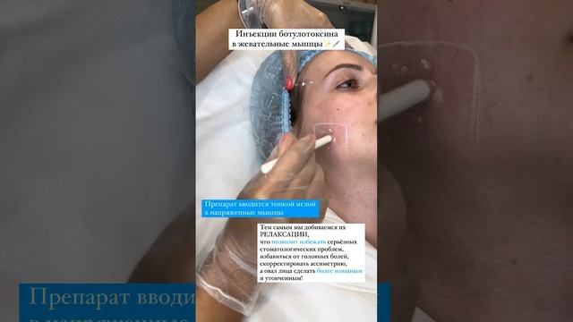 Лечение бруксизма ботоксом. #косметологмосква #ботоксмосква