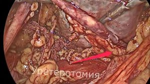 ЛАПАРОСКОПИЯ УРЕТЕРОЛИТОТОМИЯ. ИССЕЧЕНИЕ КИСТЫ ПОЧКИ