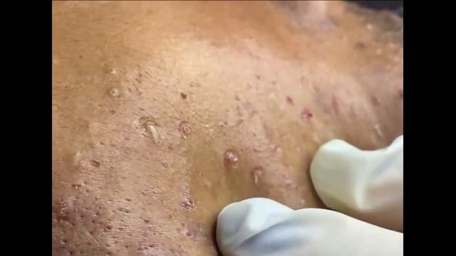 Удаление черных точек 2021 - Remoção de cravo 2021 - Pimple Popping 2021 -Blackhead Removal 2021