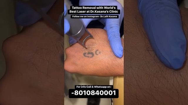 Laser Tattoo Removal Before and After II Dr.Lalit Kasana