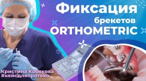 Установка Бразильских брекетов ORTHOMETRIC