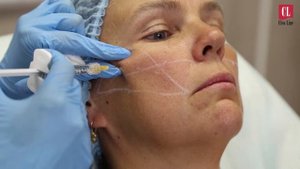 Контурная пластика средней трети лица