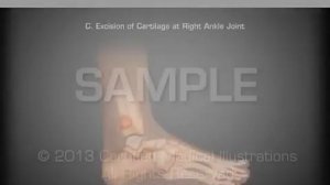 Артродез голеностопного сустава