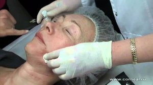 Биоревитализация - какую технику использовать